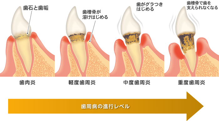 歯肉炎、歯石と歯垢、軽度歯周炎、歯槽骨が溶け始める、中度歯周炎、歯がグラつきはじめる、重度歯周炎、歯槽骨で歯を支えられなくなる